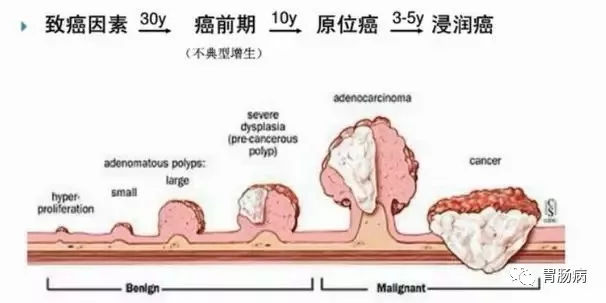 體檢查出腸息肉一定要切除！ 95%腸癌由它演變而來