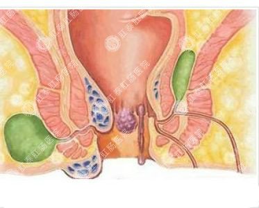 南寧哪個醫(yī)院可以做肛周膿腫？