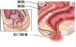 南寧治療脫肛哪家醫(yī)院好？南寧脫肛治療多少錢？